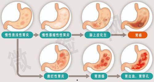 胃我想去那里,一场胃肠道之旅